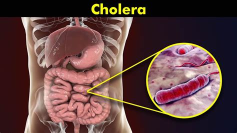 Cholera Causes Symptoms And Treatments Youtube