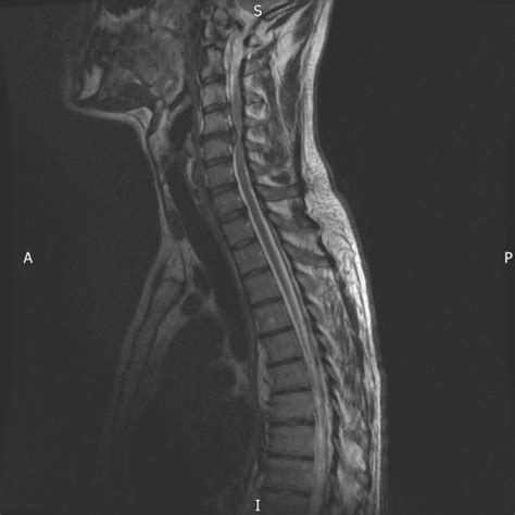 Pre Operative Mri Scan Sagittal Download Scientific Diagram