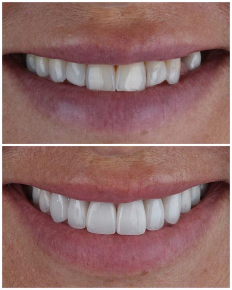 How Much Do Porcelain Veneers Cost To Maintain Sharp Dentistry And Associates