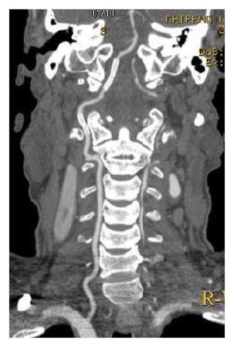 A 62 Year Old Man Case 3 With Right Intracranial Vertebral Artery