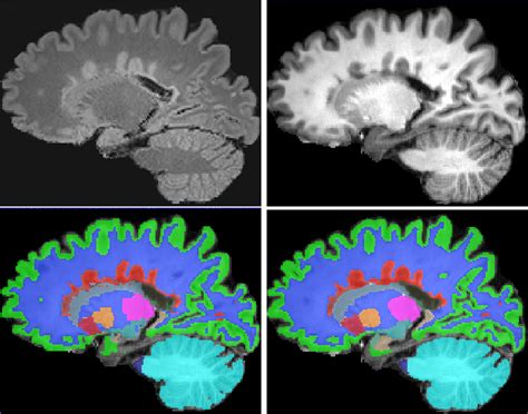 Figure 3 From Simultaneous Lesion And Neuroanatomy Segmentation In Multiple Sclerosis Using Deep