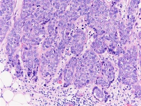 Invasive Ductal Carcinoma Histology