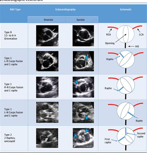 [pdf] Prognostic Implications Of Raphe In Bicuspid Aortic Valve Anatomy Semantic Scholar