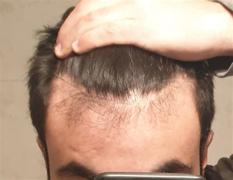 How To Tell If You Have Male Pattern Baldness Baldness Prevention