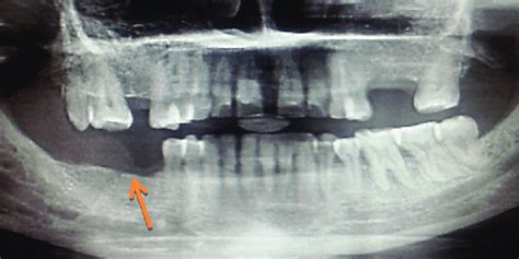 Orthopantomograph Showing Well Defined Soft Tissue Shadow On The Right