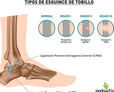 Tiempo de baja por esguince de tobillo grado 1 Cuánto dura