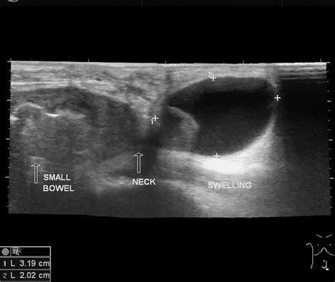 [diagram] Diagram Of Femoral Hernia Mydiagram Online