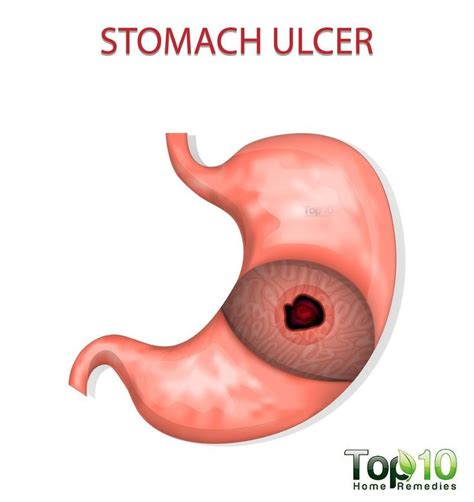 Stomach Ulcers Signs Treatment Do Home Remedies Work In 2021 Peptic Ulcer Ulcers Stomach