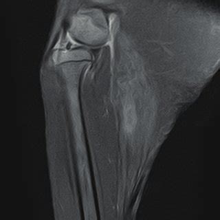 MRI of the right gastrocnemius muscle. (A) hypersignal changes and ...