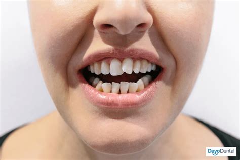 How Long Does Invisalign Take The Invisalign Timeline And Process