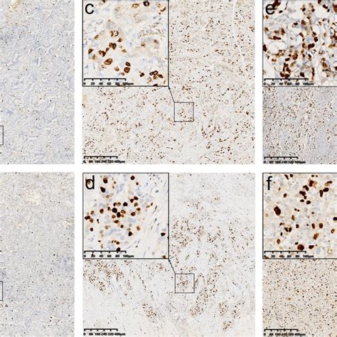 Immunohistochemical Analysis Of Ki 67 In Six Representative Samples