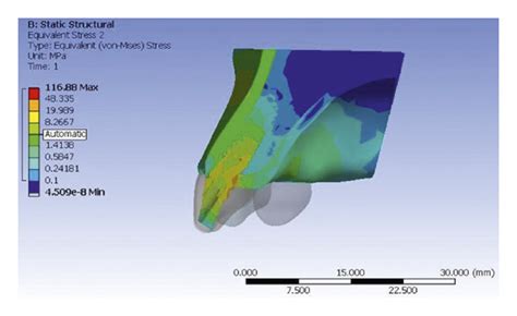 Von Mises Stress In Implant And Peri Implant Bone For Straight And Download Scientific Diagram