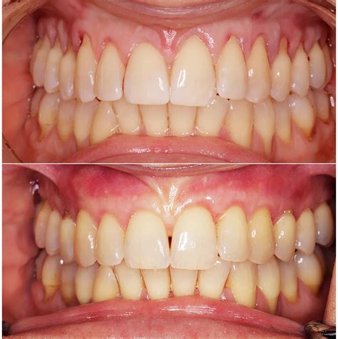 Soft Tissue Gum Graft Before And After Periodontist Nyc