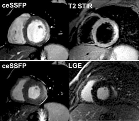 Visualization Of Oedema Late Gadolinium Enhancement Lge And Cine