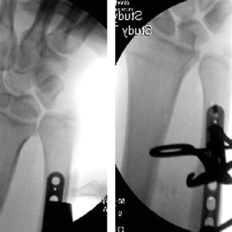 PDF Ulnar Shortening Osteotomy For Distal Radius Malunion