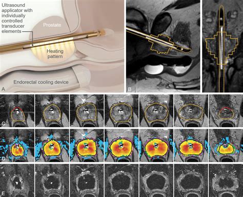 Magnetic Resonance Imaging Guided Transurethral Ultrasound Ablation Of