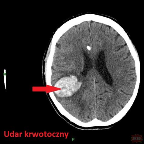 Ciekawostki medyczne 2 Udar mózgu
