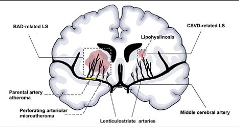 Figure 3 From Advances In Understanding The Pathogenesis Of Lacunar