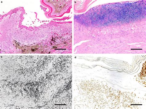 Photomicrographs Of Skin Lesions Scale Bar Represents M A