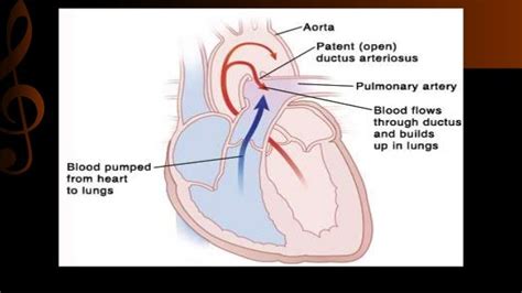 Patent Ductus Arteriosus