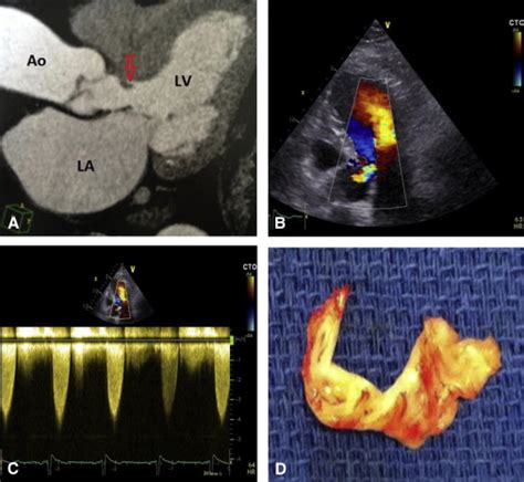 A Case Of Subaortic Stenosis The Journal Of Thoracic And Cardiovascular Surgery