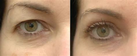 Non Surgical Eyelid Correction Stunning Skin Clinic