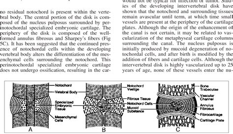 Schematic Showing Normal Development Of The Intervertebral Disk