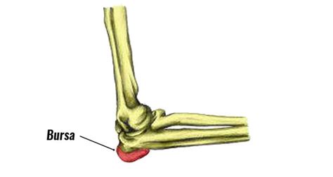 Elbow Bursitis Students Elbow Olecranon Bursitis