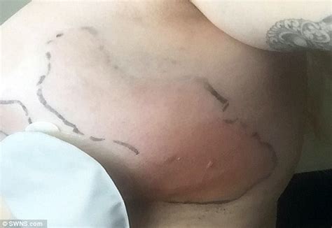 Woman Is Left With Wonky Chest After Two Botched Boob Job Operations Abroad Daily Mail Online