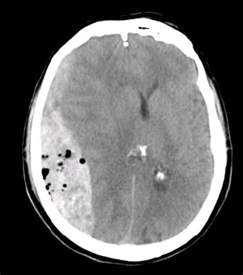 Epidurales H Matom Klinikum Brandenburg