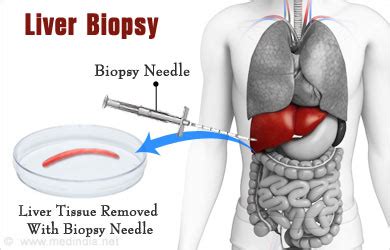 Liver Biopsy - Risks, Making Safe