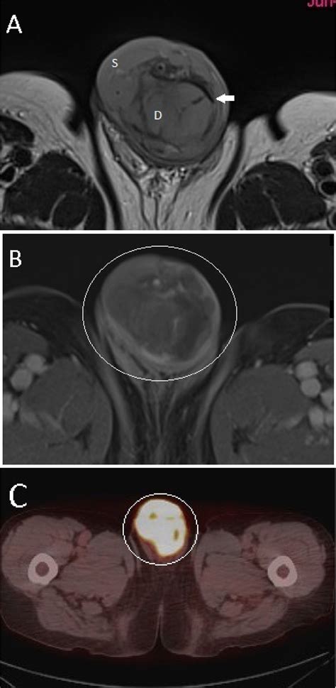 A Axial T2 Weighted Tse Imaging Demonstrates An Infiltrative