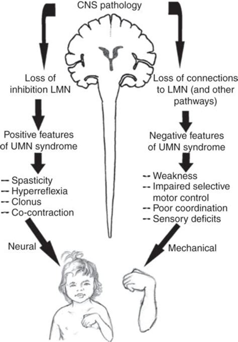 Pathophysiology Of Cerebral Palsy Mezaun Lakha Evin Executive