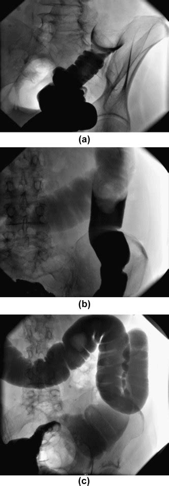 Imaging Manifestations Of Faecal Impaction And Stercoral Perforation Clinical Radiology