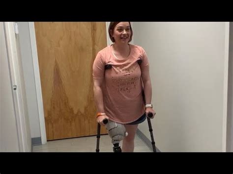 Above Knee Amputee First Prosthetic Leg Fitting First Steps Youtube