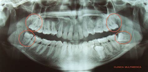 Odontología Elsa Asociados Tercer molar o molar del juicio