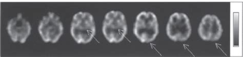 Craniocerebral Diseases Radiology Key