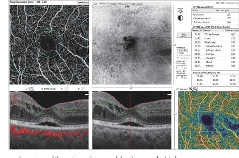 Figure 2 From Evaluation Of Foveal Avascular Zone And Capillary Plexuses In Diabetic Patients By