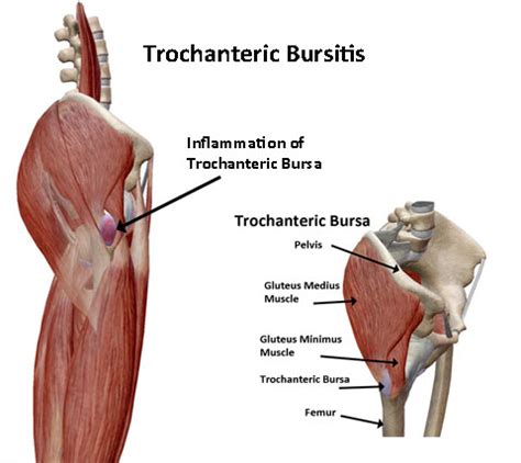 Trochanteric Bursitis Coastal Virginia Spine Pain Center