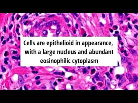 Pathology Of Angiolymphoid Hyperplasia With Eosinophilia By Dr Sampurna