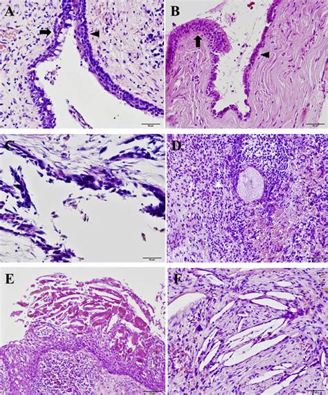 Digital Mucous Cyst Histology