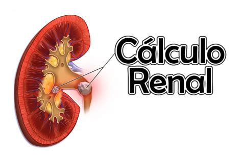 Abh Ngig Madison Grund Calculo En El Ureter Kohl Glanz Artikel