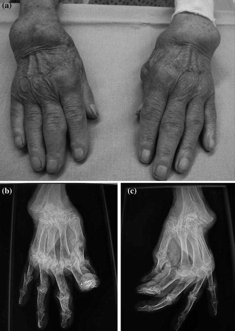 The Wrist Joint Affected By Rheumatoid Arthritis Musculoskeletal Key