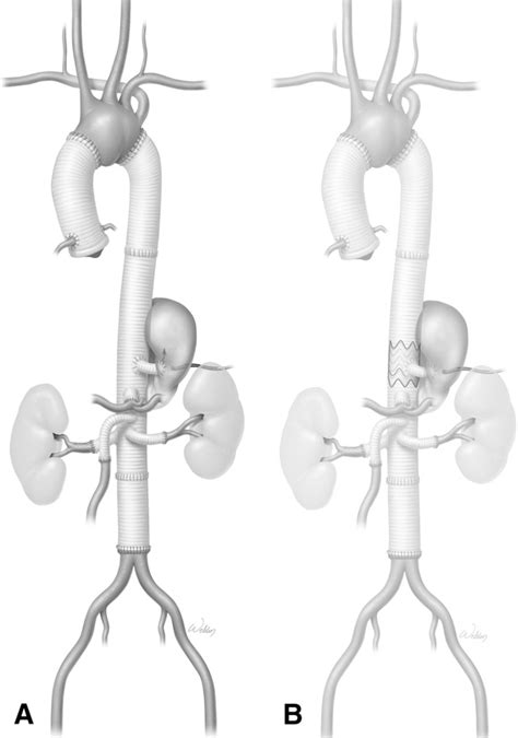 Figure From Endovascular Repair Of Thoracic Aortic Pseudoaneurysms