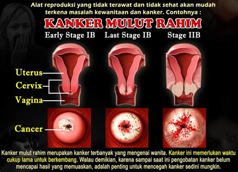 Penyebab Kanker Servik Newstempo