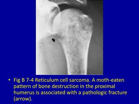 Moth Eaten Or Punched Out Osteolytic Destructive Lesions Of Ppt