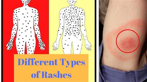 How To Describe Rashes