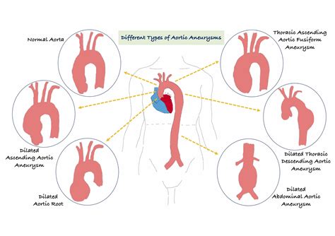 Aorta And Aortic Dissections Questions Answered By Dr Sabiha Gati Myheart