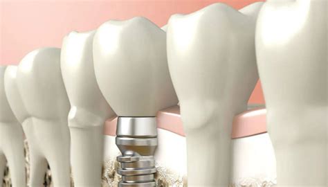 Dental Implants In Turkey Prices Advantages Full Mouth And Same Day