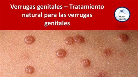 Verrugas Genitales Tratamiento Natural Para Las Verrugas Genitales